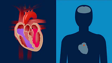 Sind Herzrhythmusstörungen und Vorhofflimmern das gleiche?