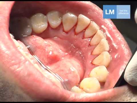 Periodontal treatment protocol