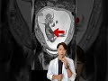 【ドクターリアクション】胎児の中に胎児!?#shorts #MRI画像
