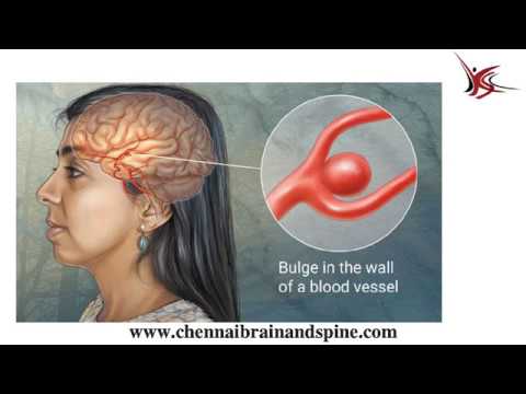 Headache And Head Pain Treatment In Chennai Brain Aneurysm Treatment In Tamil Nadu India Youtube