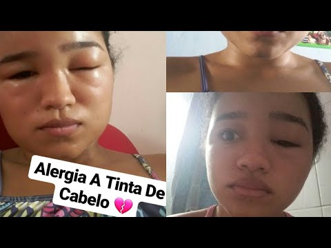 ALERGIA A TINTA DE CABELO???