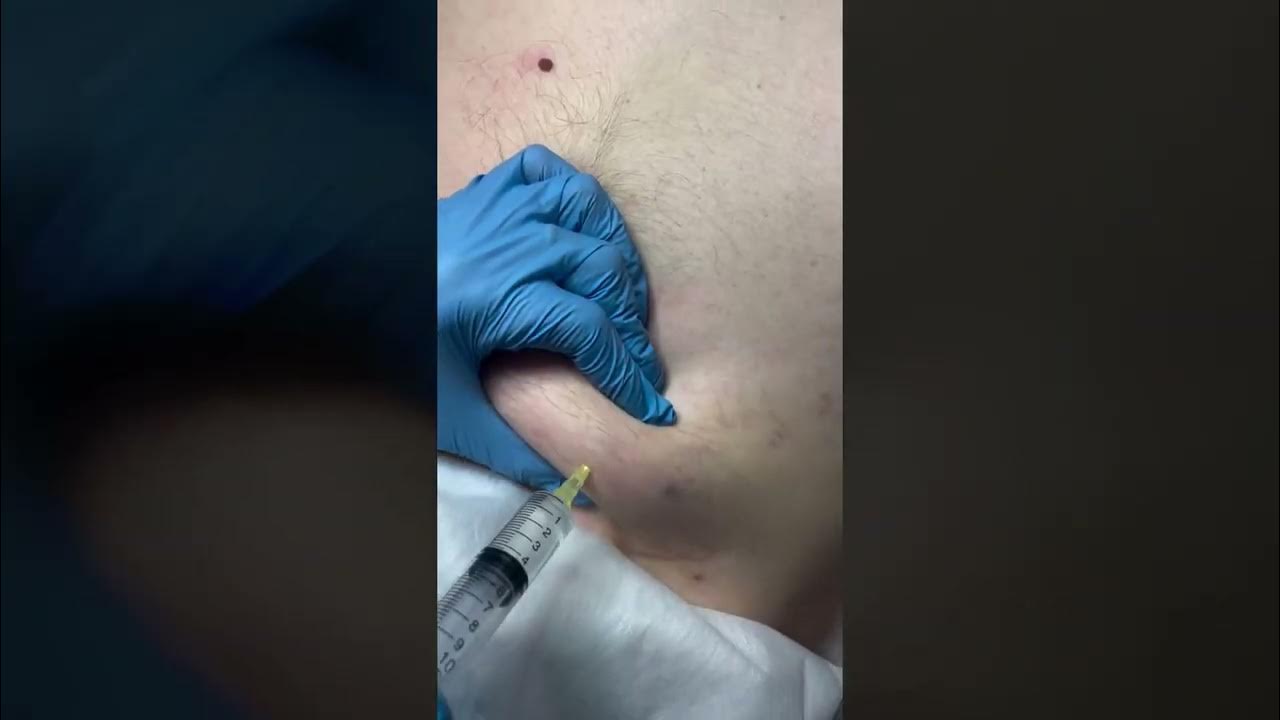 Липолитический Коктейль| Косметолог Лифтинг Пилинг Чистка Лица Кожа ...