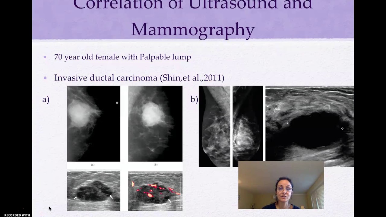 Mammography And Ultrasound In Screening And Diagnosis Of Breast Cancer Youtube