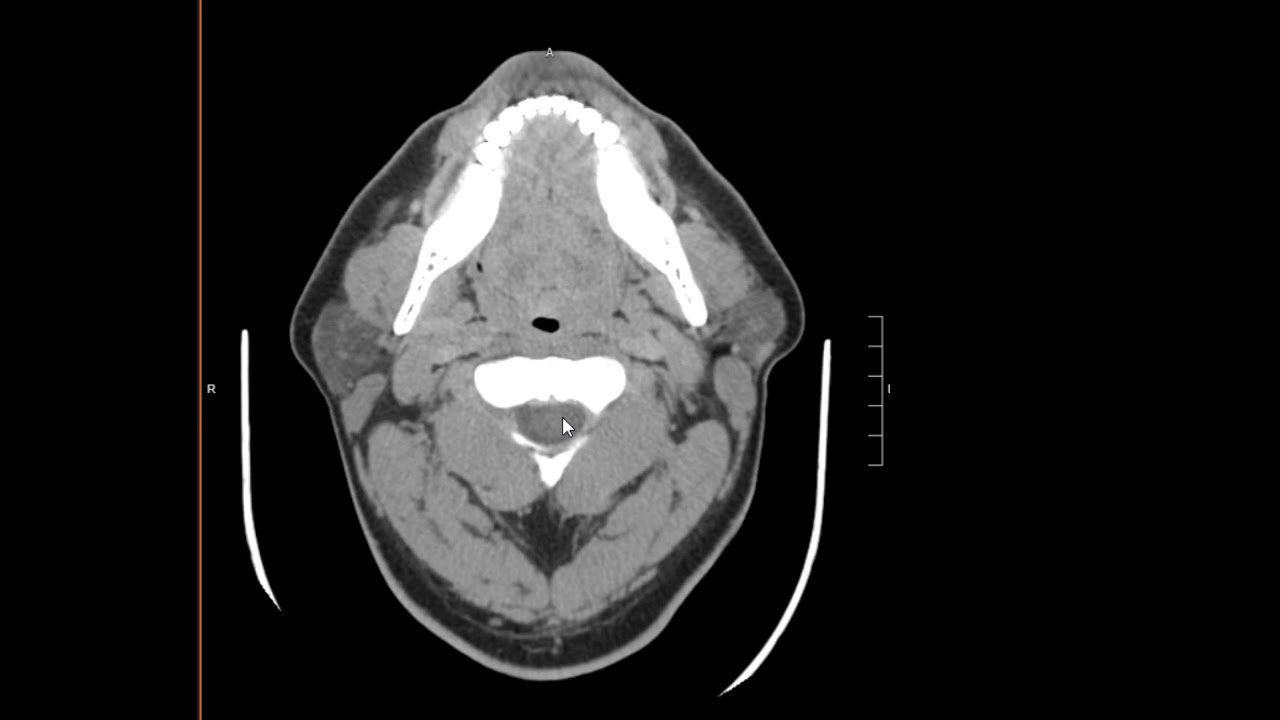 Normal Ct Neck Youtube