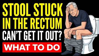 Stool STUCK in the Rectum Do THIS, Not That (Doctor Explains)