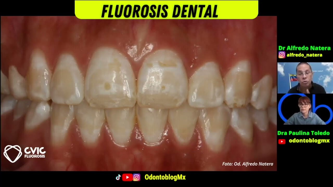Tratamiento de la FLUOROSIS DENTAL Dental Clinic