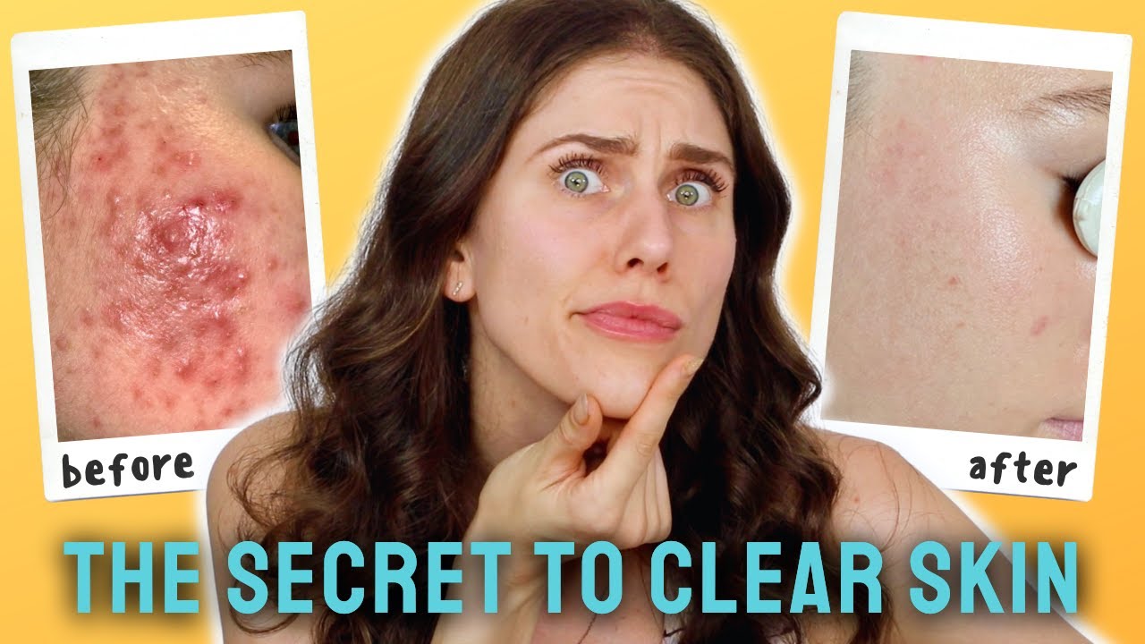 5 Ways Estheticians Treat Acne Acne Certification With Face Reality