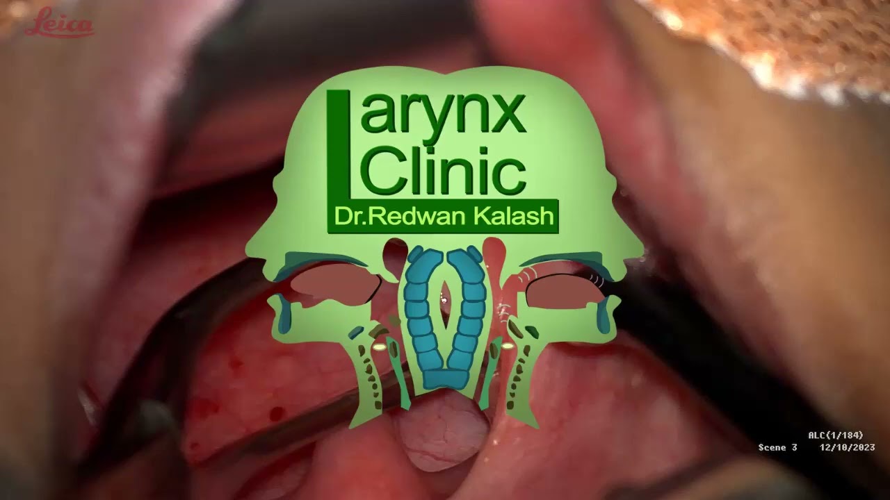 Coablation bleed-less tonsillectomy real time surgery