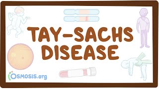 Tay-Sachs disease - causes, symptoms, diagnosis, treatment, pathology