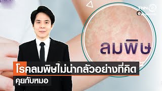 โรคลมพิษไม่น่ากลัวอย่างที่คิด⎜คุยกับหมอ⎜7 พ.ย. 64