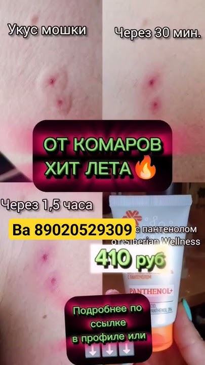ВОЛДЫРИ ОТ КОМАРОВ ПРОЙДУТ МГНОВЕННО🔥🔥ПРОСТО НАНЕСИ ЭТО НА УКУС - YouTube
