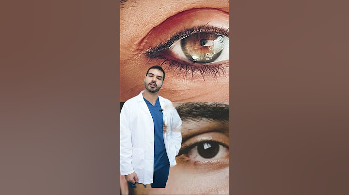 Cómo se ve un ojo con glaucoma