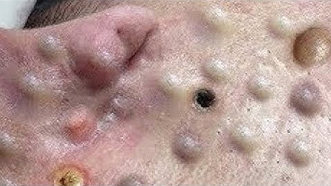 Most Satisfying Blackhead Pops Ever! 😳