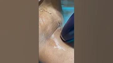 DEPILÇÃO A LASER COM O INFINITY 