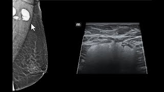 Impregnação de linfonodos axilares por silicone. Achados da mamografia e da ultrassonografia.