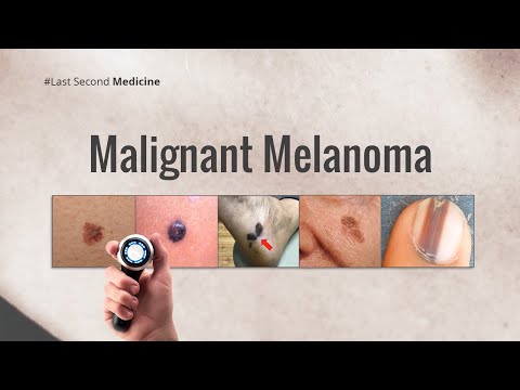 Malignant Melanoma - YouTube