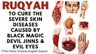 Ultimate Ruqyah to cure severe Skin Diseases,Infections&Allergies due to Black Magic,Jinn&Evil Eyes by The Power of Quran 33,968 views 3 months ago 28 minutes