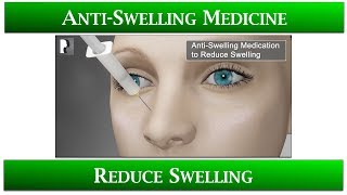 1st Appointment after Rhinoplasty- 5 Anti-Swelling Medicine to reduce swelling: Speed up healing