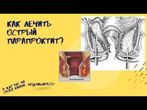 Как лечить ОСТРЫЙ ПАРАПРОКТИТ?