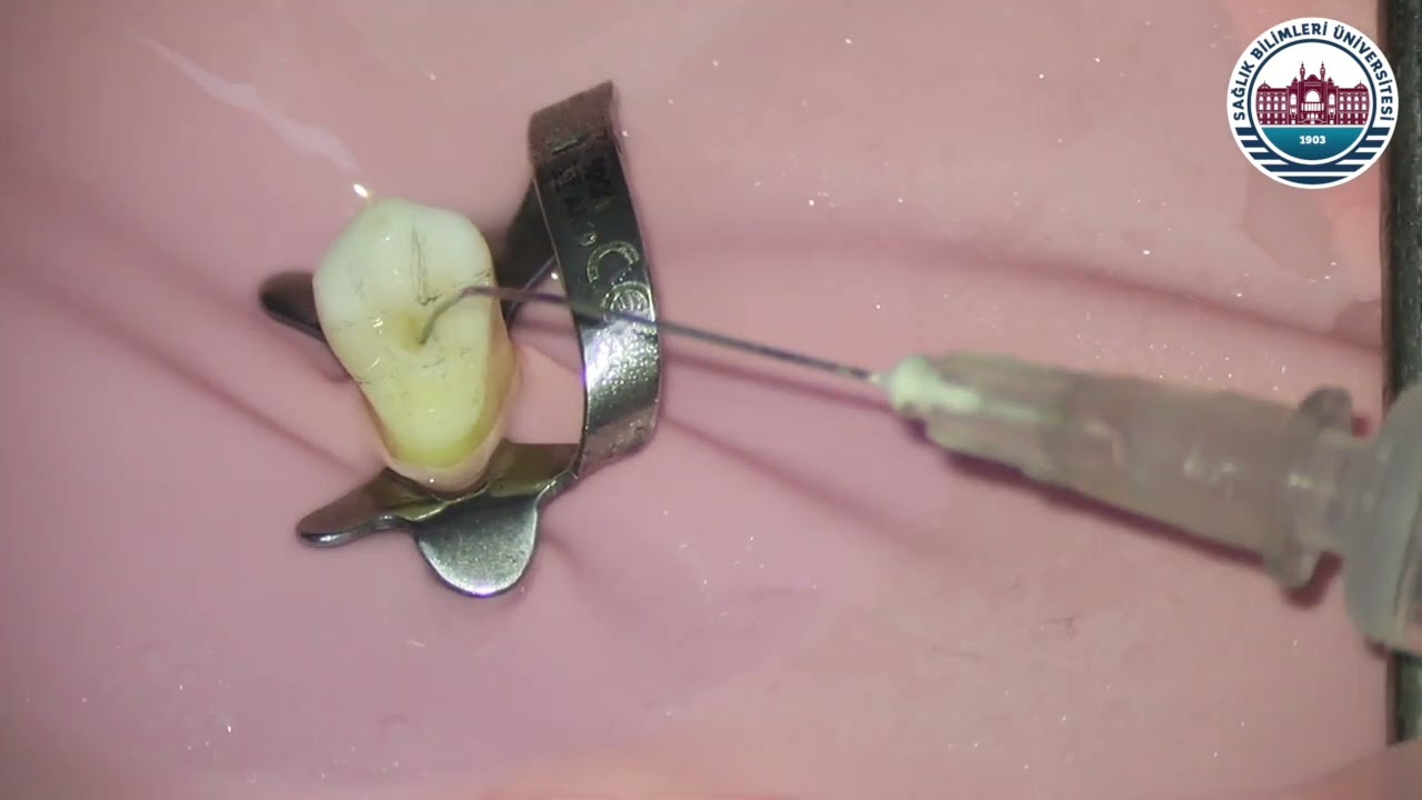 Üst Kanin Endodontik Giriş Kavitesi