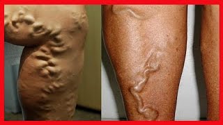 Quebradas tornozelos veias nos