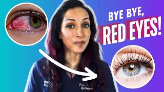 How To Get Rid Of Red Eyes Fast