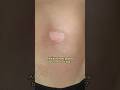 [Must See] Vitiligo Completely Healed! Your New Hope. #Shorts