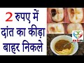 सिर्फ एक बार इस्तेमाल से दांत का कीड़ा बाहर निकालें / How To Get Rid Of Tooth Cavity 100% Effective