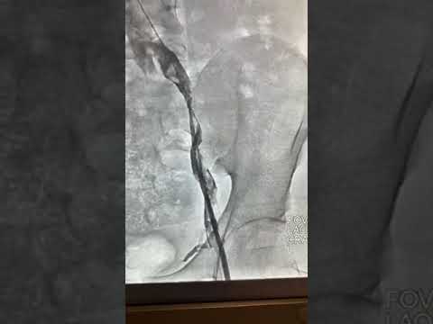 Trombosis Venosa por catéter de diálisis | Dr. Juan de Dios Candia Camacho