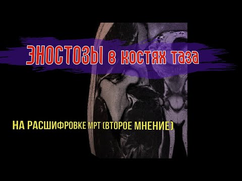 КОКСАРТРОЗ тазобедренного сустава и ЭНОСТОЗЫ в костях таза на расшифровке МРТ (ВТОРОЕ МНЕНИЕ)