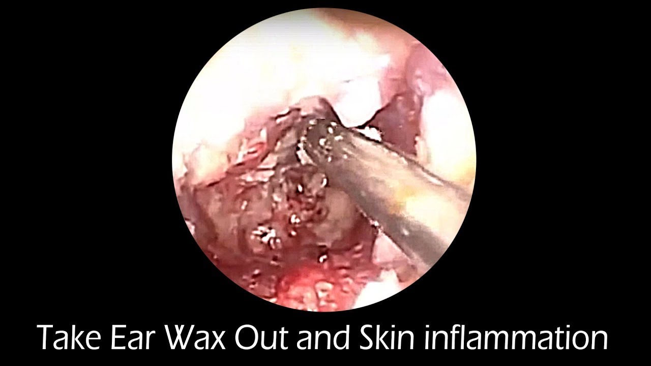 Take Ear Wax Out and Skin inflammation Of Ear With Relaxing Music - YouTube