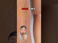 Hablemos de las Varices