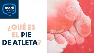 ¿Qué es el pie de atleta? #MediConsultas