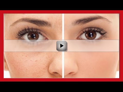 How to Get Rid of Acne Scars Naturally and Fast Overnight?