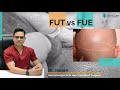 Which technique is best ? | FUT vs FUE Technique | Best Hair Transplant Surgeon- Dr. Jangid | Delhi