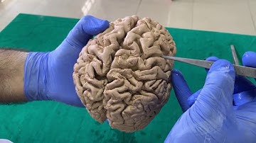 Dissection - Sulci & Gyri of Superolateral surface of brain