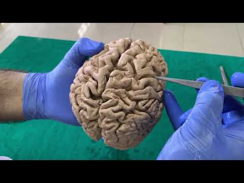 Dissection - Sulci & Gyri of Superolateral surface of brain