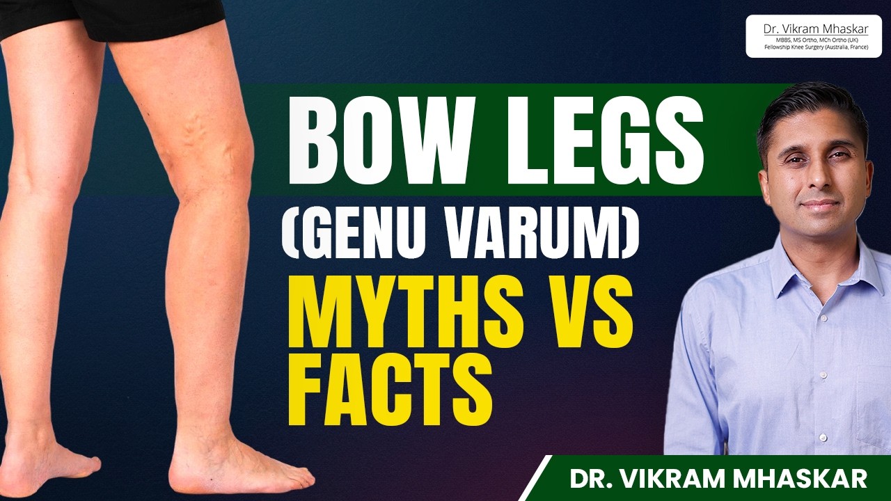 Bow Legs : Myths vs Facts | Can Exercises, Shoes, or Surgery Straighten Your Legs?