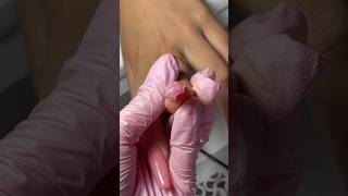 Nail Beak correction ? nailtutorial nailrepair nails nailshape manicuretutorial acrygel nail