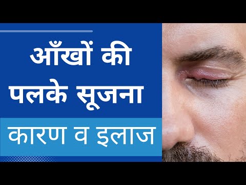 आँखों/ पलकों की सूजन :कारण और इलाज | Swollen eyelids : Causes and Treatment in Hindi
