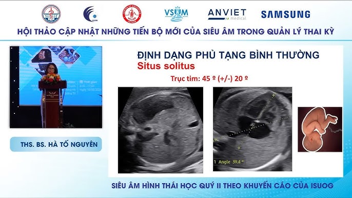 Image hình ảnh hình ảnh hình ảnh hình ảnh hình ảnh hình ảnh hình ảnh hình ảnh Nguyễn Hoàng Long - Sàng lọc lệch bội hiện nay – ThS.BS. Nguyễn Hoàng Long - YouTube