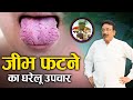 ज भ फटन क घर ल उपच र Hakim Suleman Khan Sadhna TV ज भ फटन क घर ल उपच र Hakim Suleman Khan Sadhna TV