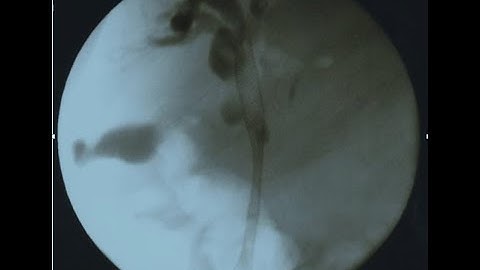 Cholangiocarcinoma ERCP Metallic Stent Deployment #BD_ENDOSCOPY