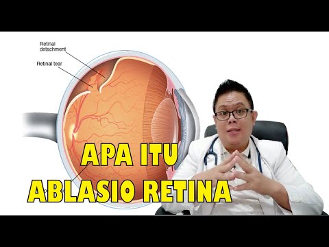 Video: Apakah ablasio retina bersifat herediter?