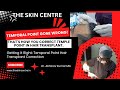 Temple creation in Hair transplant gone wrong! Get it corrected by Dr Abhinav Kumar , MD ( ISHRS).