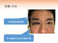 眼窩内出血の治り方