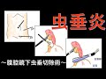 これだけ知っていればOK、腹腔鏡下虫垂切除術のメリット、デメリット【医師解説】