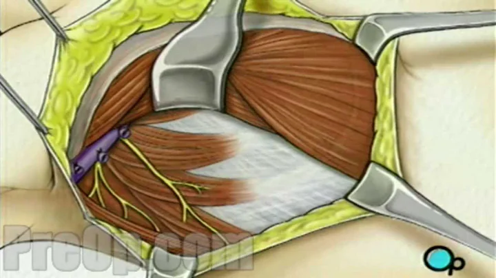 Mastectomy Modified Radical Patient Education Medical Videos - DayDayNews