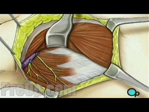 Mastectomy Modified Radical Patient Education Medical Videos