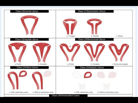 Doğumsal Rahim Anormallikleri, Rahim Perdesi, Çift Rahim, T rahim, Didelfis, Bikornis, Arkuat rahim